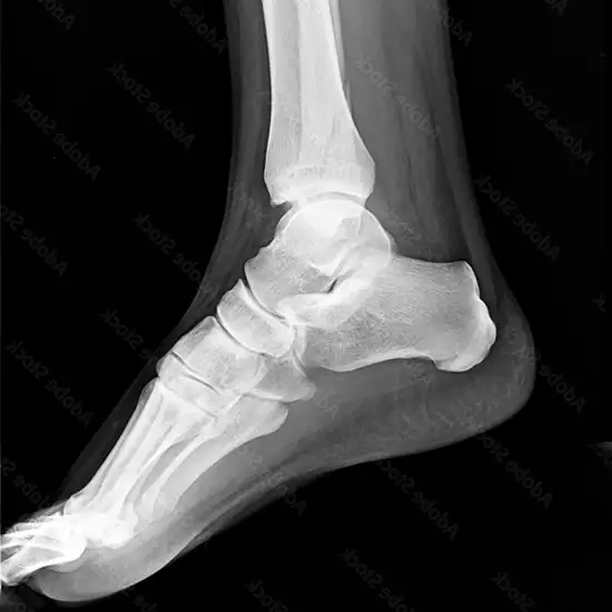 MRI Right Foot